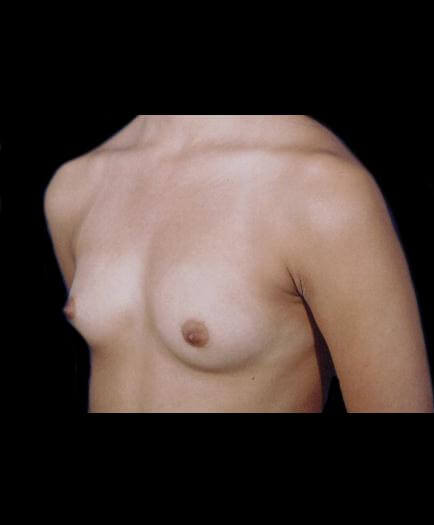 Before Breast Augmentation Left Side View