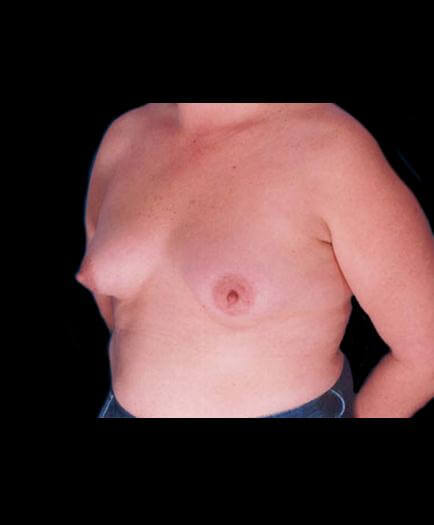 Breast Augmentation Before