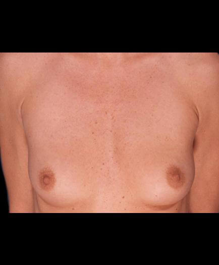 Breast Implants Before