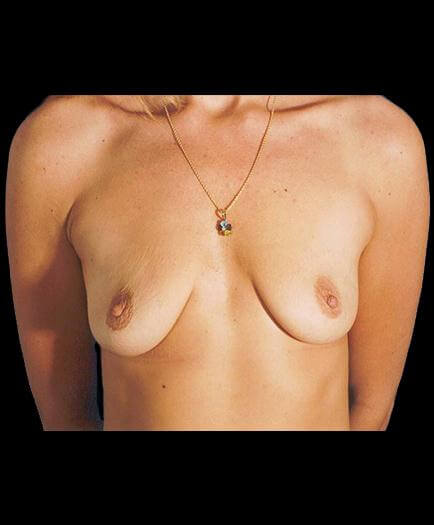 Before Virginia Breast Augmentation