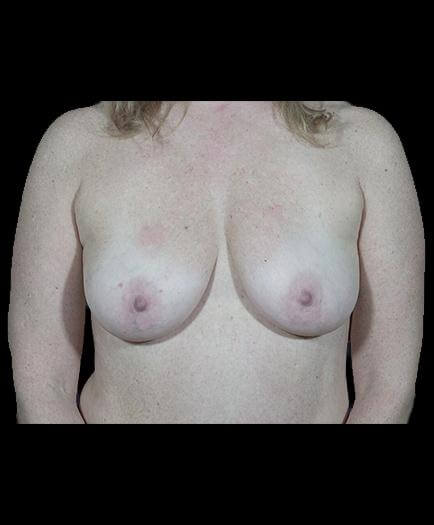 Breast Implant Surgery Before