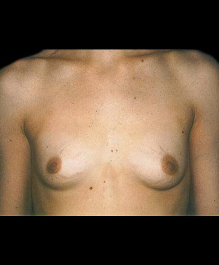 Before Virginia Breast Implants