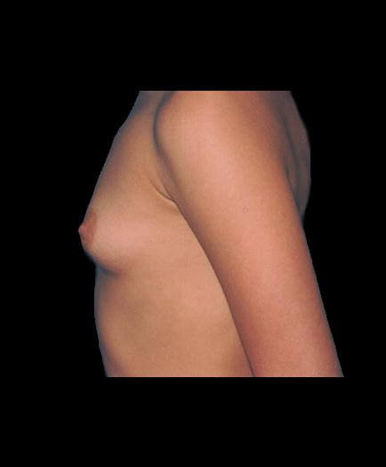 Before Breast Implant Surgery Left Side View