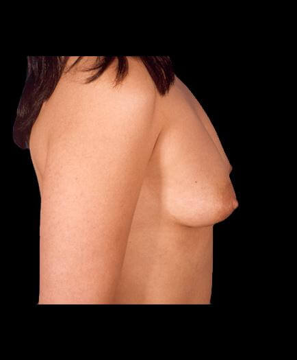 Breast Implant Surgery Before Right Side View