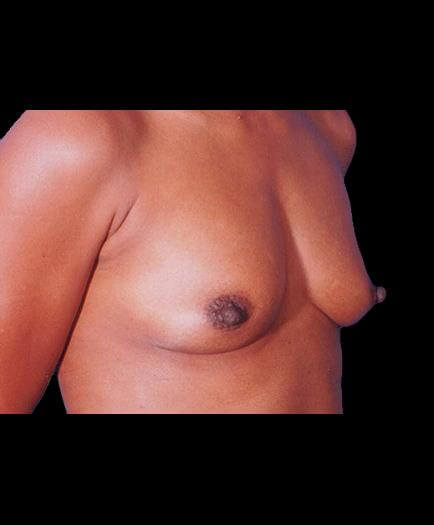 Before Breast Implant Surgery Right Side View