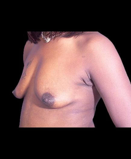 Before Breast Augmentation Left Side Image