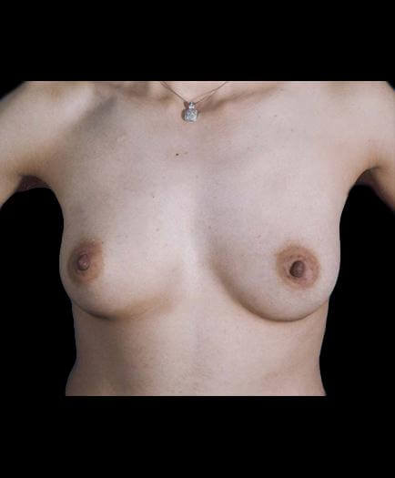 Breast Augmentation Before Image