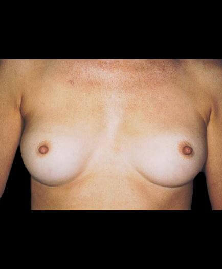 Breast Implants Before Image