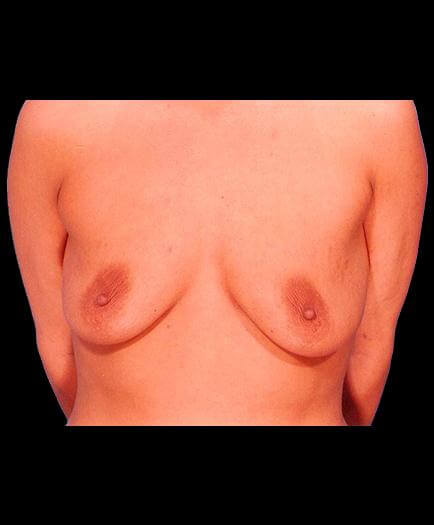 Breast Augmentation Before View