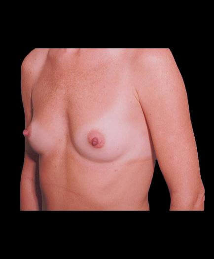 Breast Implants Before View