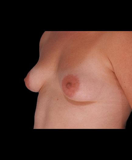 Breast Augmentation Surgery Before View