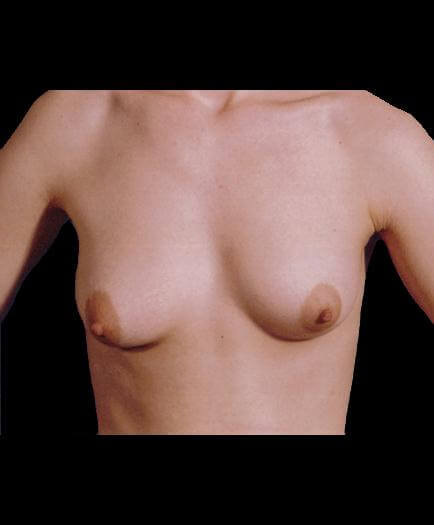 Breast Implant Surgery Before View