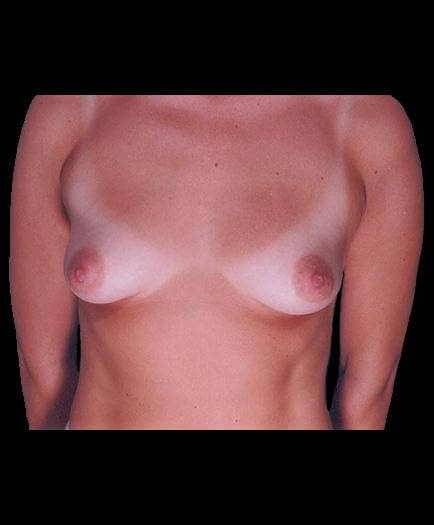 Breast Augmentation Before Photo