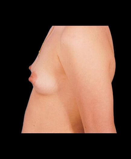 Breast Implants Before Photo