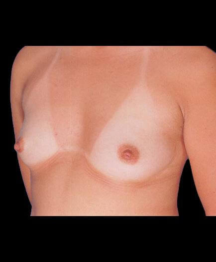 Breast Augmentation Surgery Before Photo