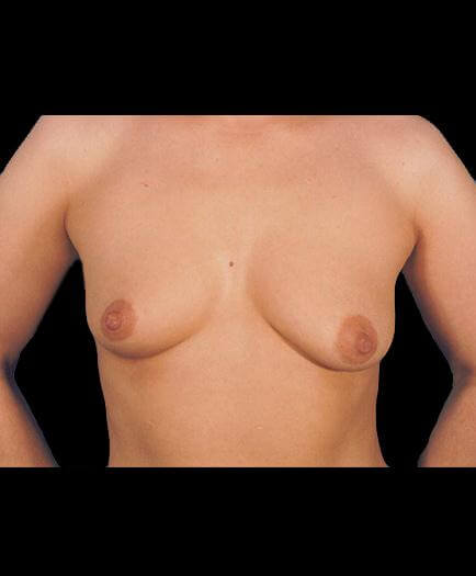 Breast Implant Surgery Before Photo