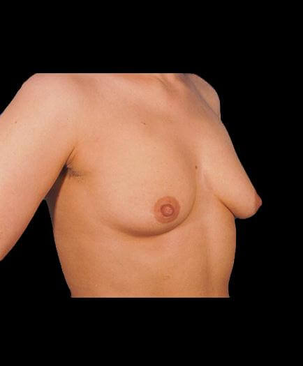 Breast Implant Surgery Before Right Side Photo