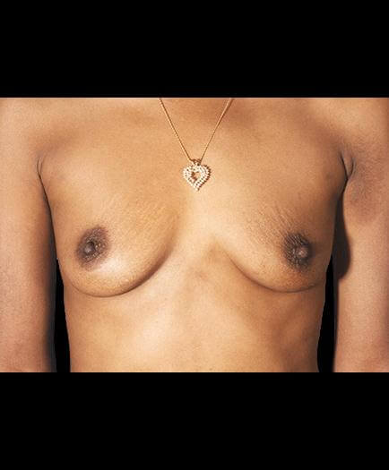 Breast Augmentation Before Picture