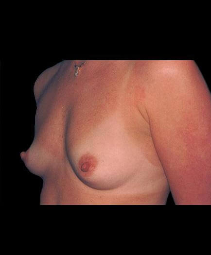 Breast Implants Before Picture