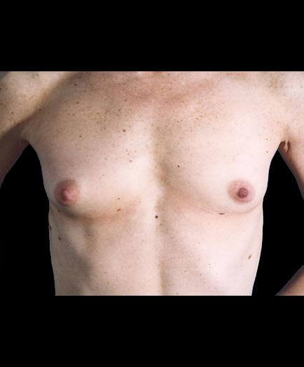 Breast Augmentation Surgery Before Picture