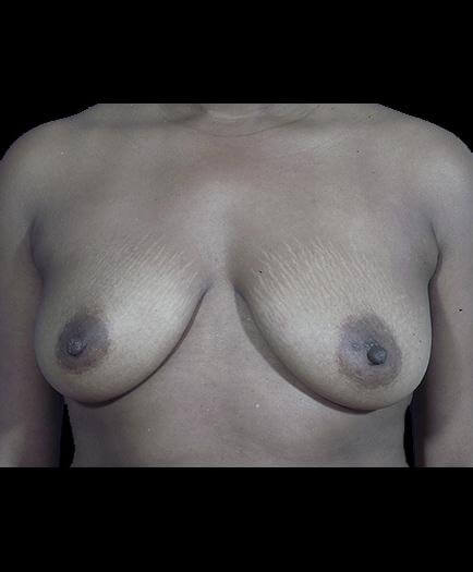 Before Breast Augmentation View