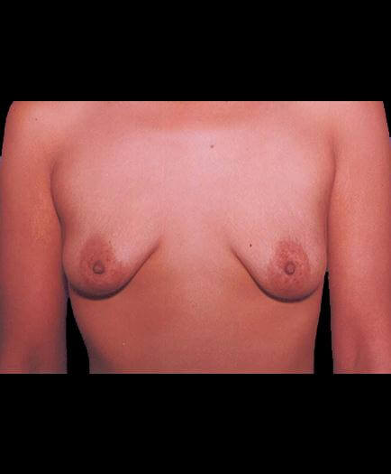 Before Breast Implants View