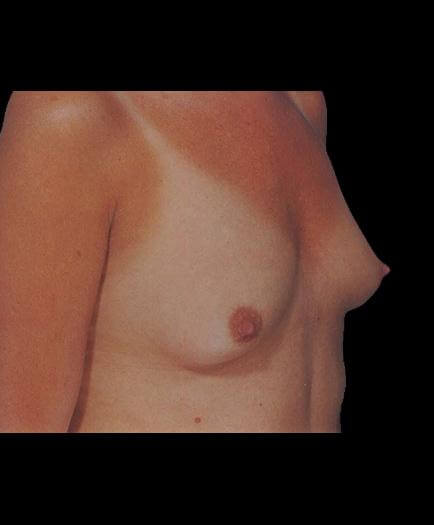 Before Breast Augmentation Surgery View