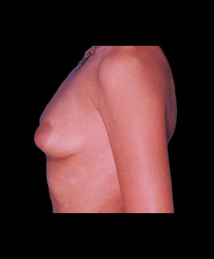 Before Breast Implant Surgery View