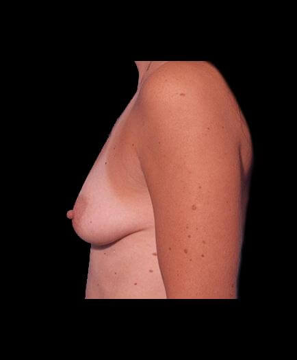 Before Breast Augmentation Photo