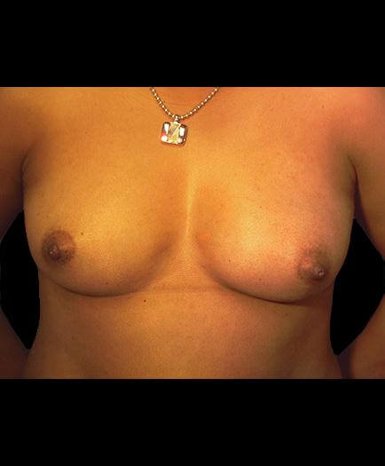 Before Breast Augmentation Surgery Photo