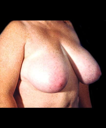 Before Breast Reduction Surgery