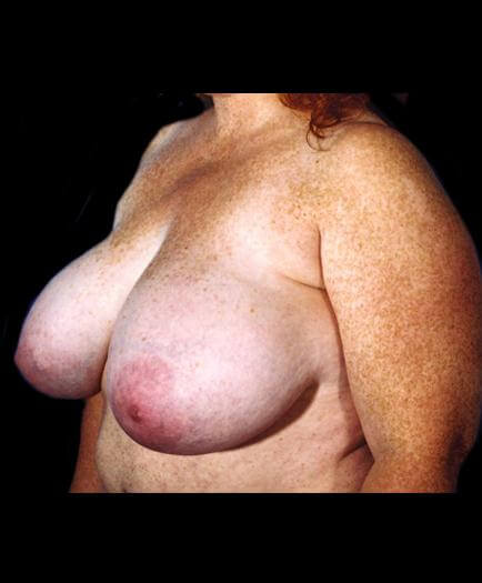 Breast Reduction Surgery Before