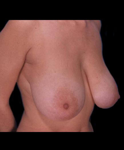 Virginia Reduction Mammoplasty Before Photo