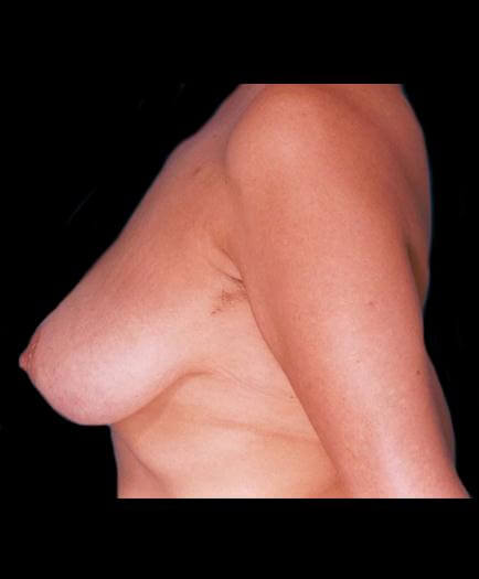 Reduction Mammoplasty Surgery Before Photo