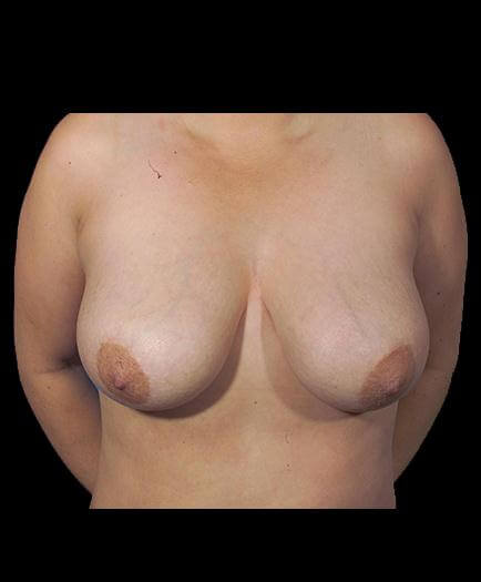 Breast Reduction Before Image