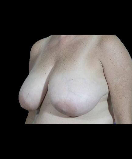 Reduction Mammoplasty Before Image