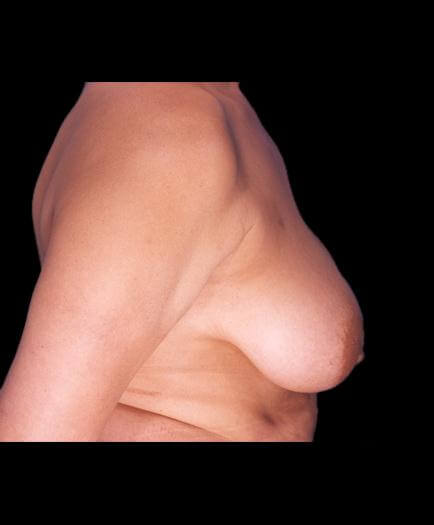 Reduction Mammoplasty Surgery Before Image