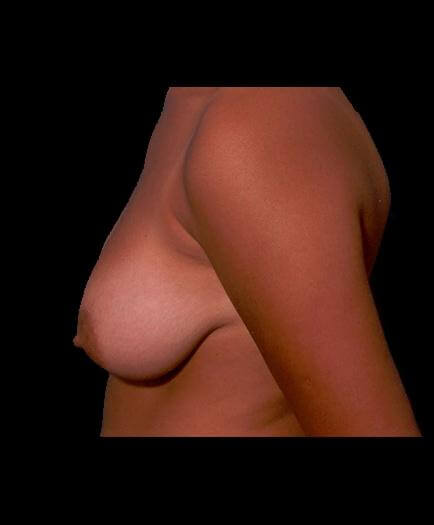 Virginia Reduction Mammoplasty Surgery Before Image