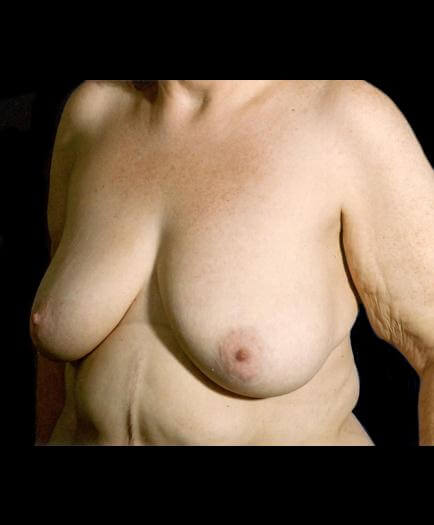 Before Breast Lift Surgery