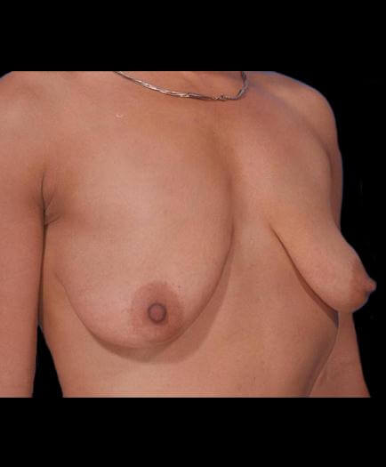 Breast Lift Before