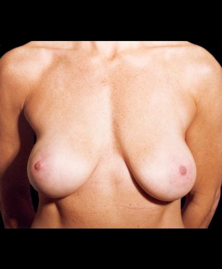 Breast Lift Surgery Before
