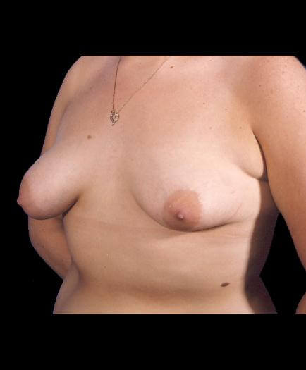 Breast Lift Before Photo