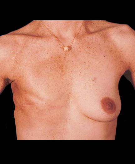 Before Breast Reconstruction