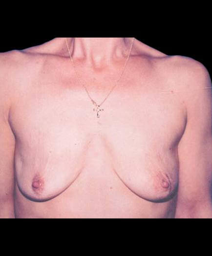 Breast Reconstruction Before Photo