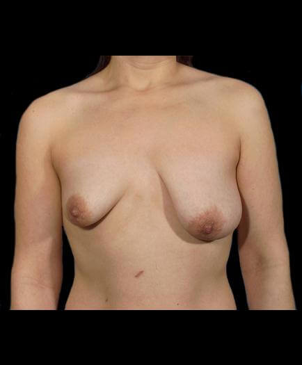 Breast Asymmetry Front View Before