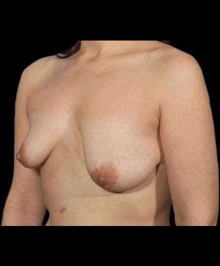 Breast Asymmetry Quarter View Before	