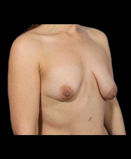Breast Asymmetry Before