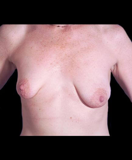 Breast Asymmetry Surgery Front View Before