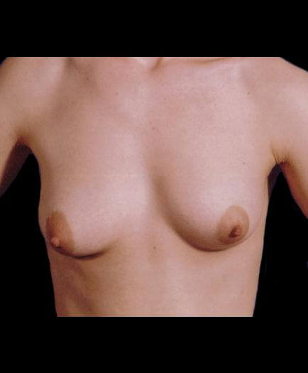 Breast Asymmetry Correction Front View Before