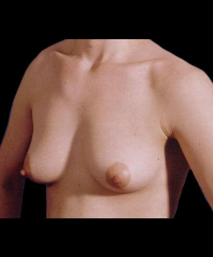 Breast Asymmetry Correction Quarter View Before